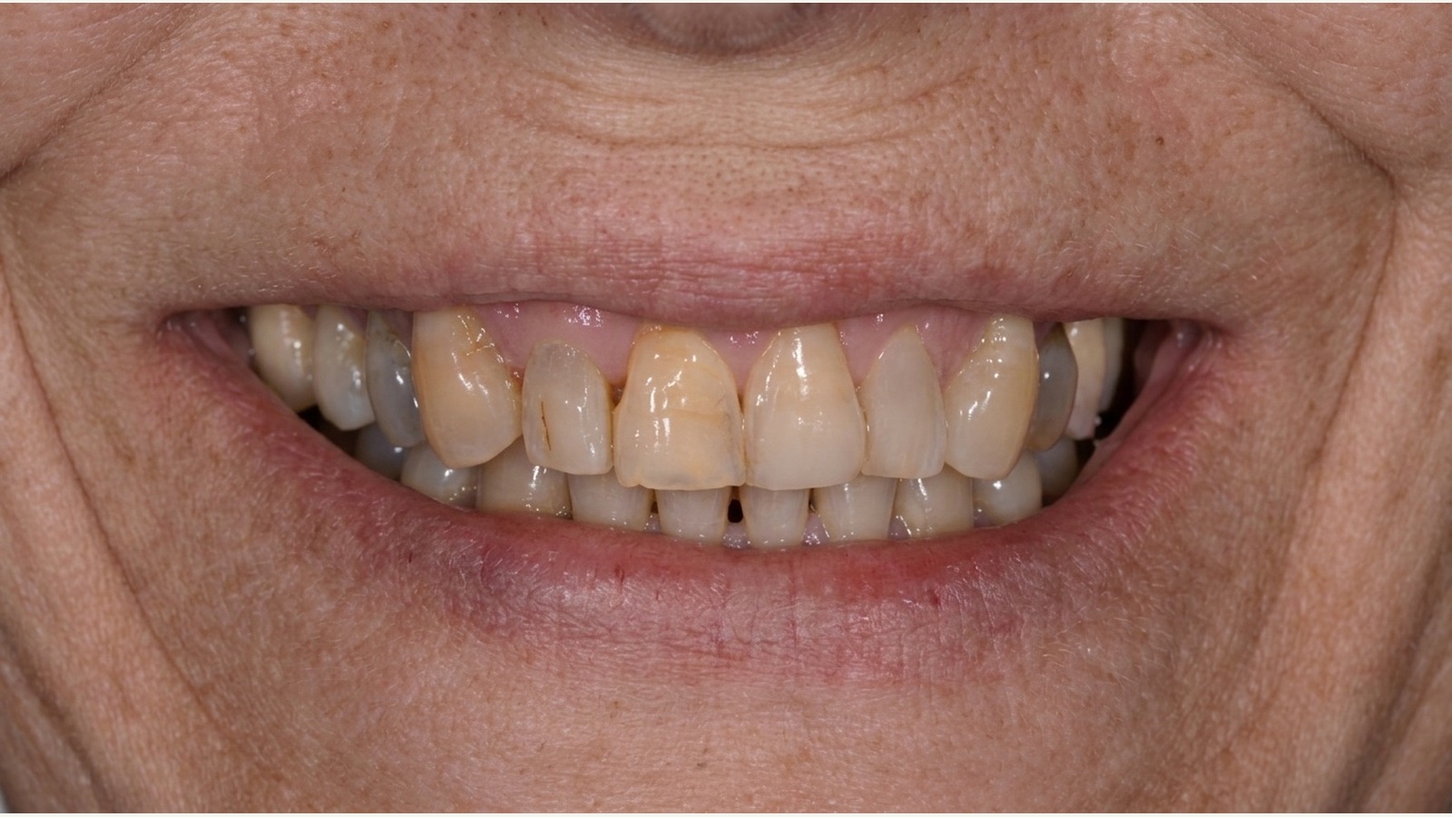Antes de tratamiento estético dental en Clínica Velke