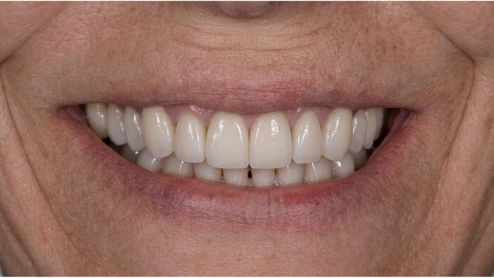 Después de tratamiento estético dental en Clínica Velke