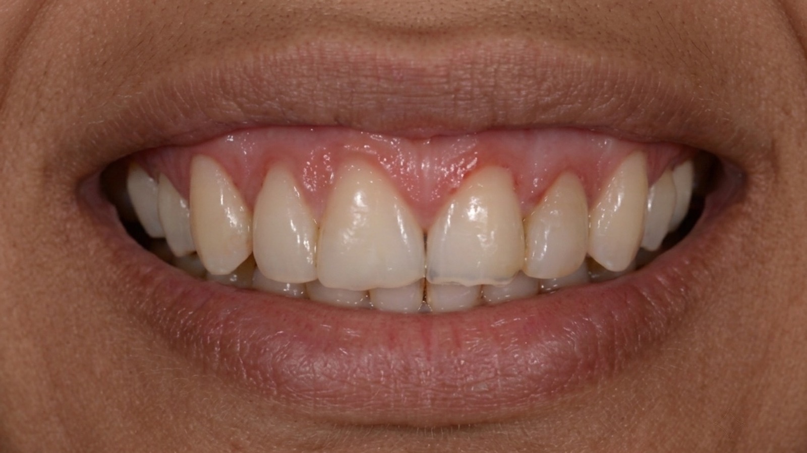 Antes de corrección estética de sonrisa en Clínica Velke