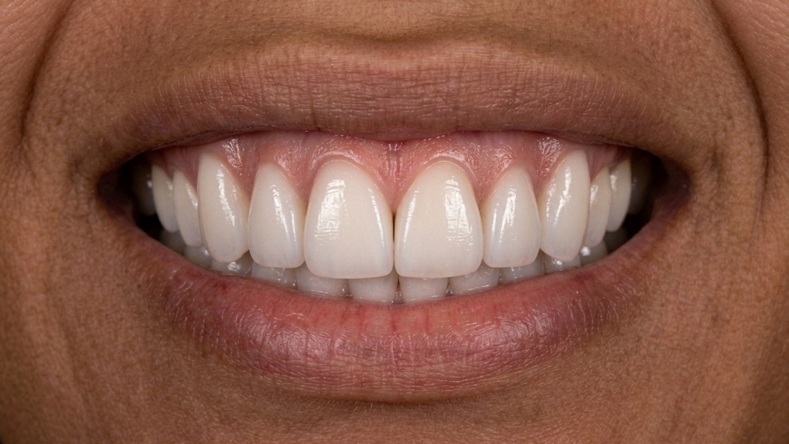 Después de corrección estética de sonrisa en Clínica Velke